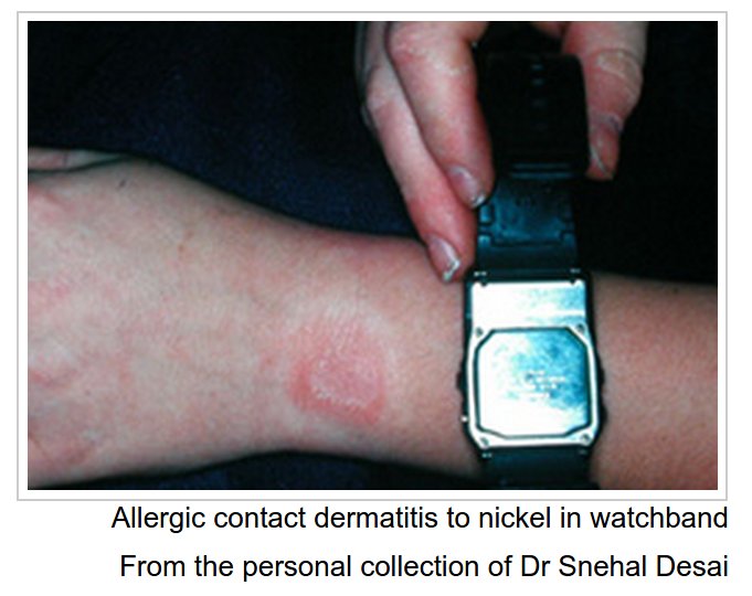 allergic dermatitis